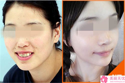 整容要花多少錢就整一張臉？深度解析全臉整形費(fèi)用構(gòu)成與預(yù)算攻略